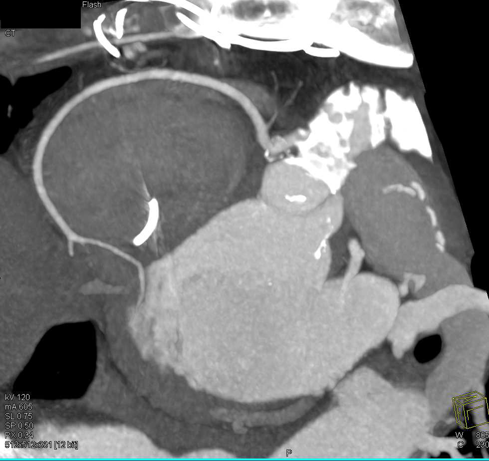 CCTA: Minimal Plaque in Left Anterior Descending Coronary Artery - CTisus CT Scan