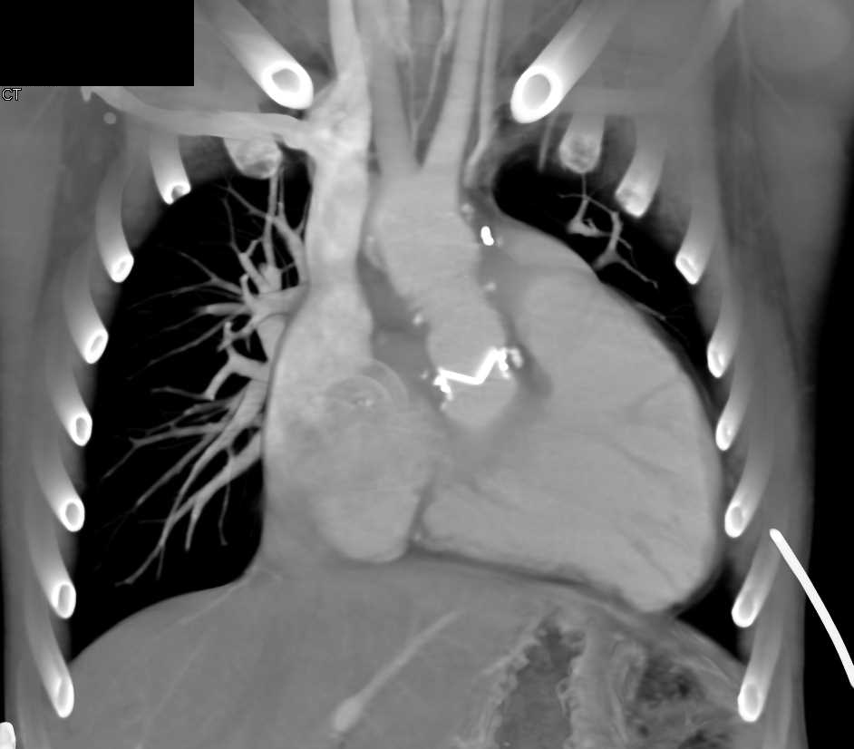 Aortic Valve Replacement with Ascending Aorta Repair as well as Amplatzer Occluder Device - CTisus CT Scan