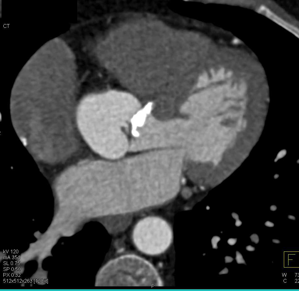 Aortic Stenosis with Extensive Aortic Valve Calcification - CTisus CT Scan