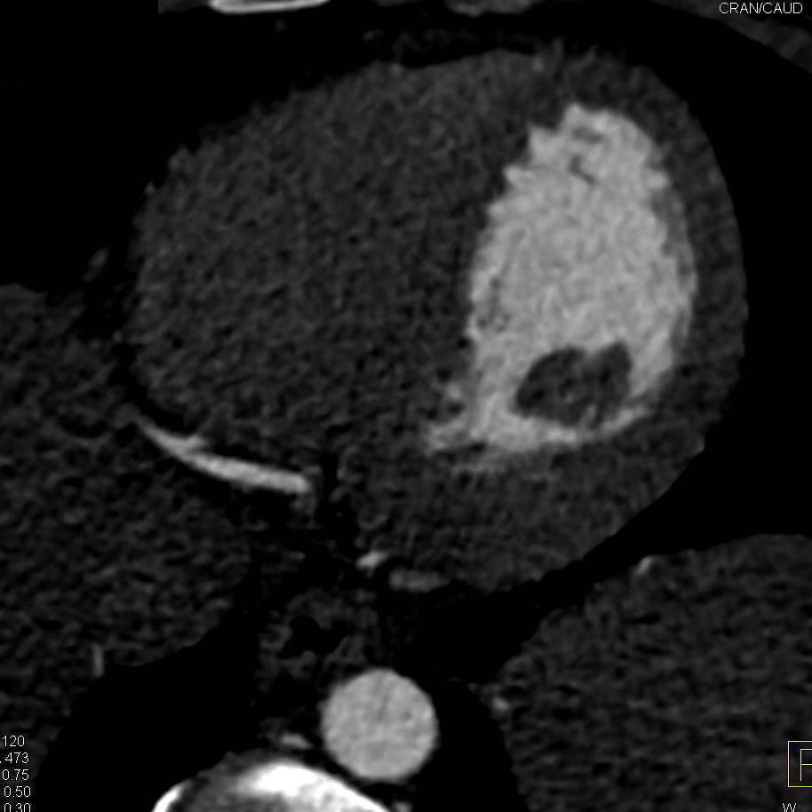 Normal Coronary CTA - CTisus CT Scan
