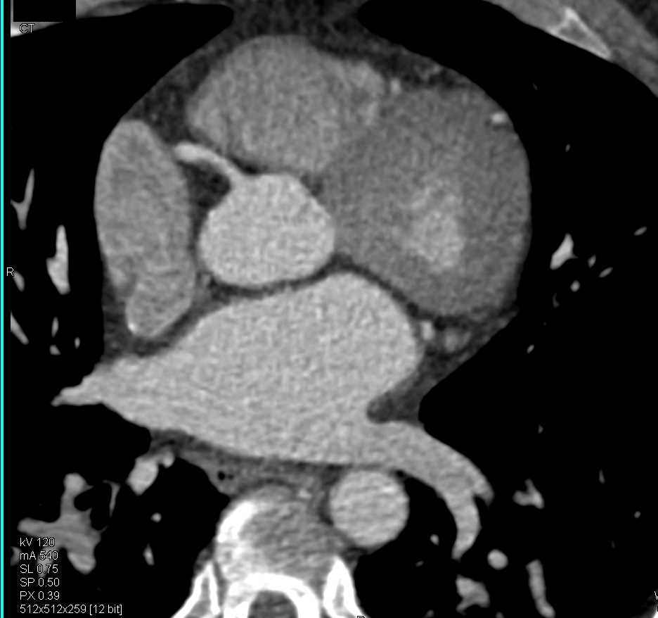 Cardiac CTA with Occluded Right Coronary Artery - CTisus CT Scan