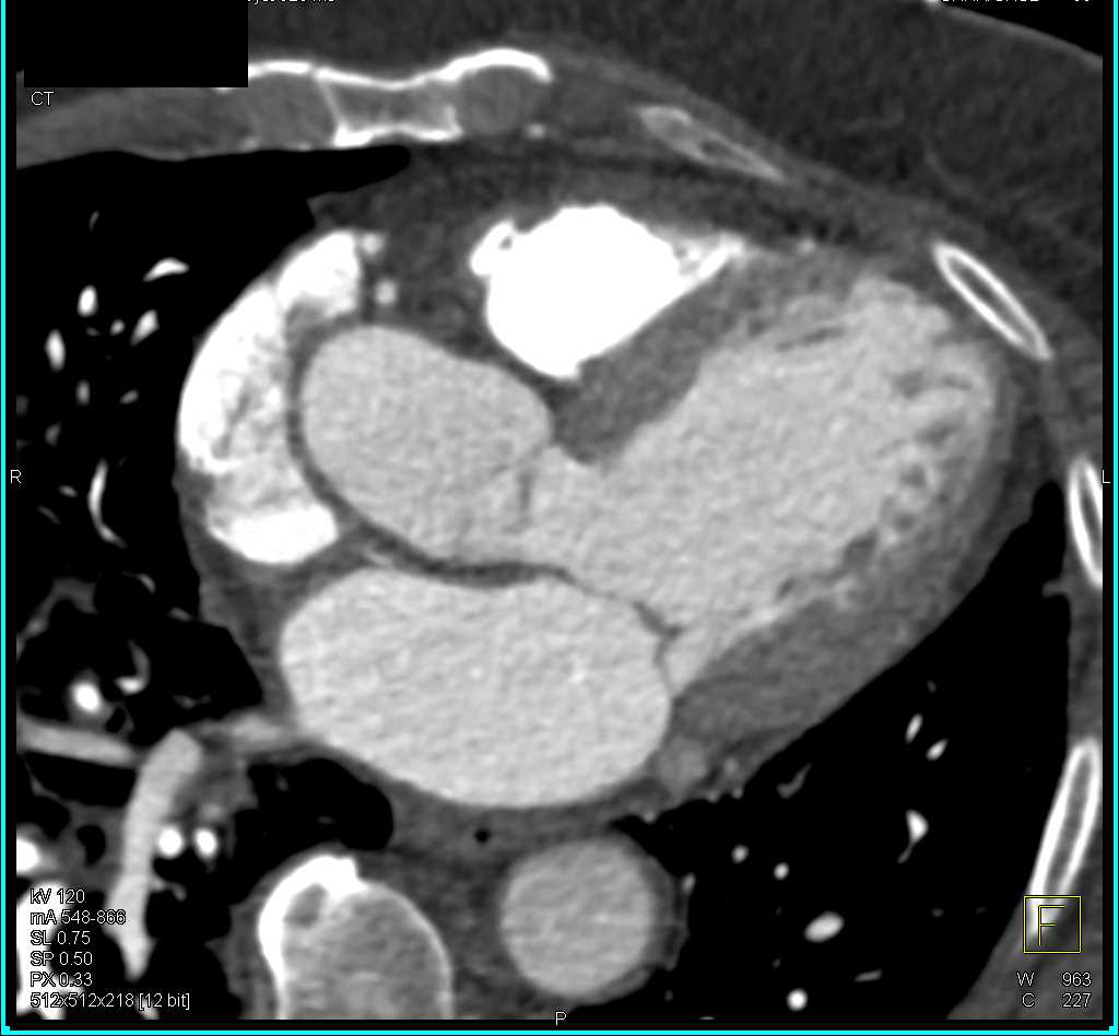 Enlarged Left Ventricle - CTisus CT Scan