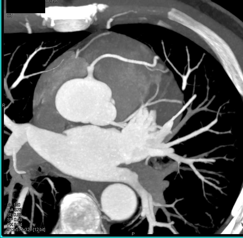 CCTA: Right Coronary Artery (RCA) and Left Coronary Artery Arise from a Common Trunk - CTisus CT Scan