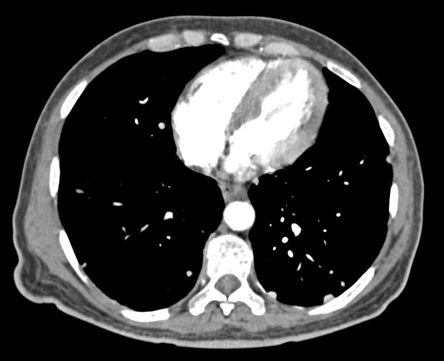 Metastatic Renal Cell Carcinoma to the Heart, Lungs, Liver and Adenopathy - CTisus CT Scan