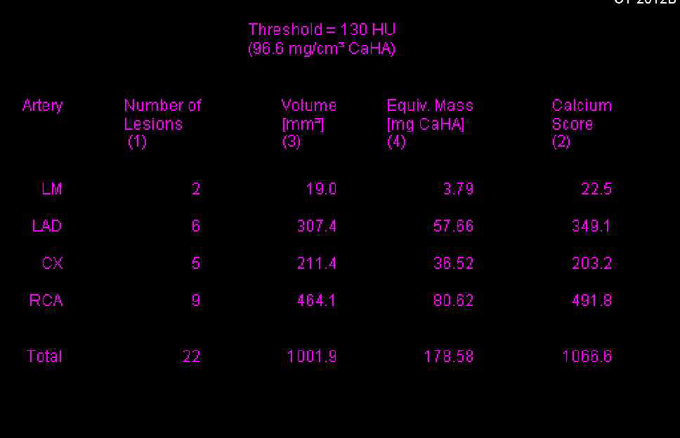 CCTA: Agatston Score Over 1000 Agatston Units in a Patient with Right Coronary Artery (RCA) Occlusion - CTisus CT Scan