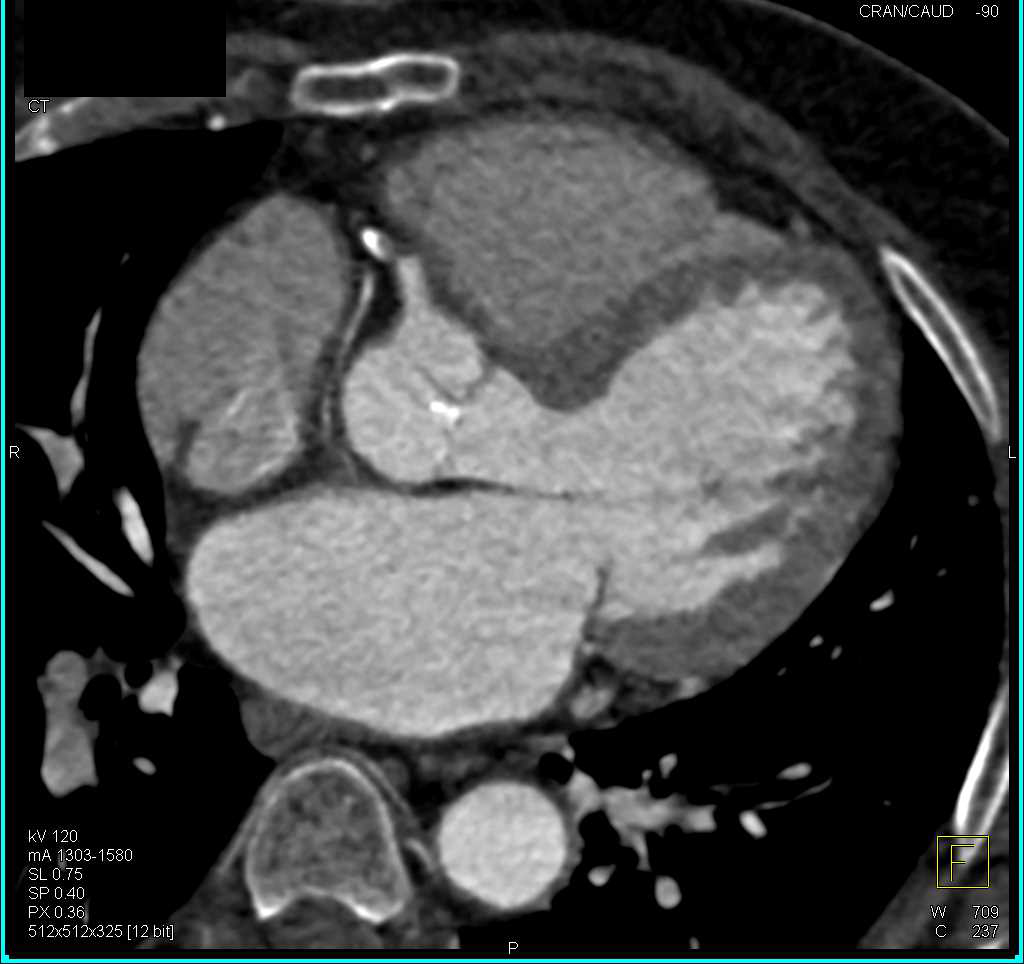 CCTA with Critical Stenosis in Right Coronary Artery (RCA) - CTisus CT Scan