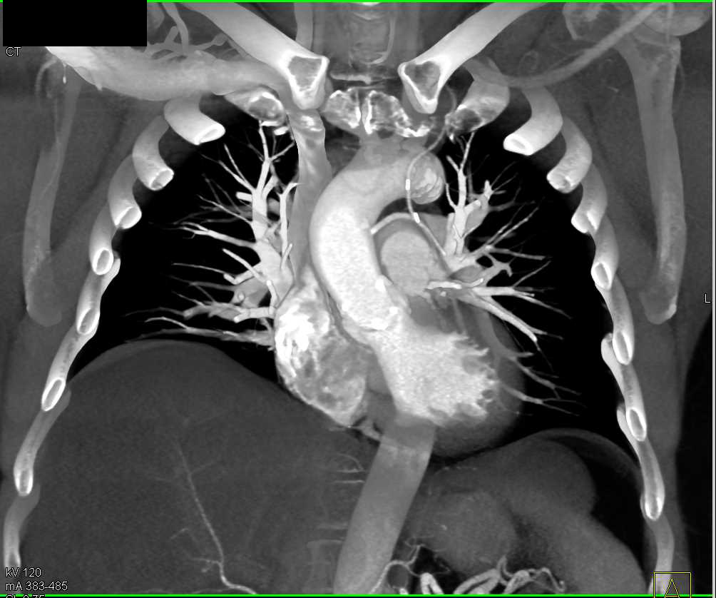 Coronary Artery Bypass Surgery with Left Internal Mammary Artery (LIMA) and Venous Bypass Grafts - CTisus CT Scan