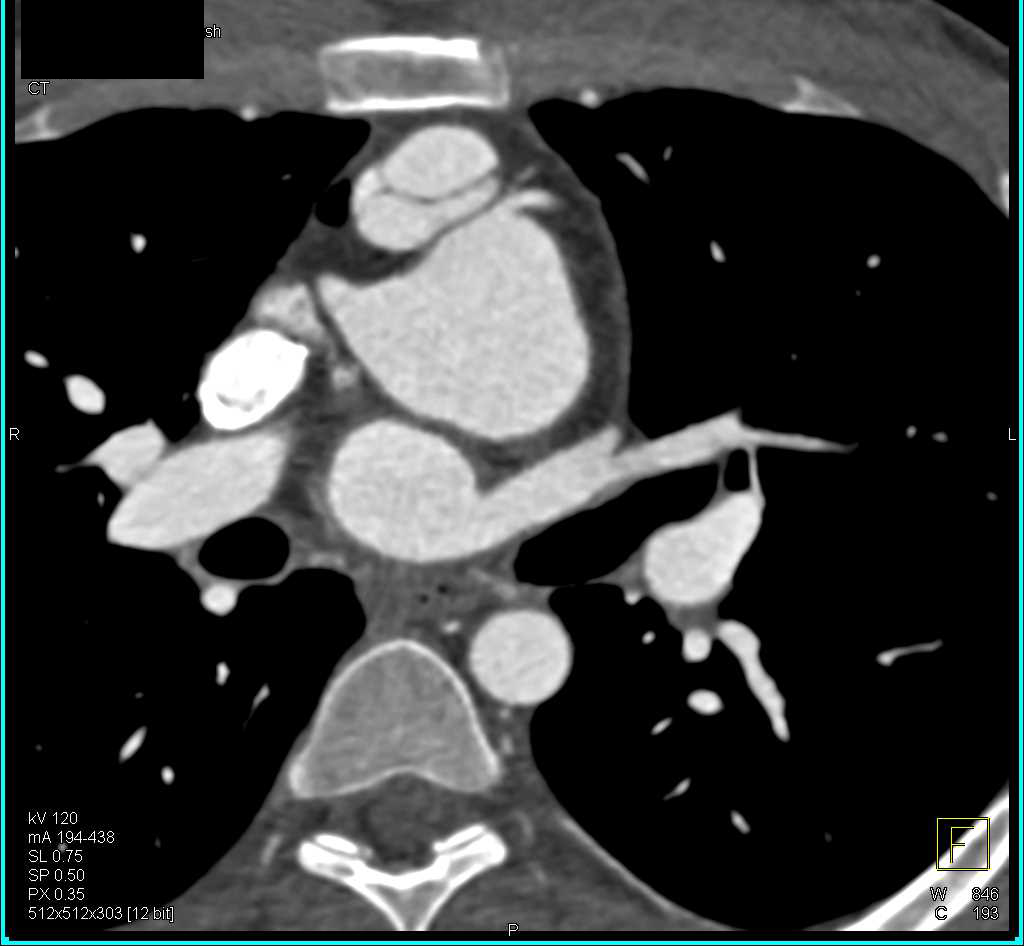Transposition of the Great Vessels with Repair - CTisus CT Scan