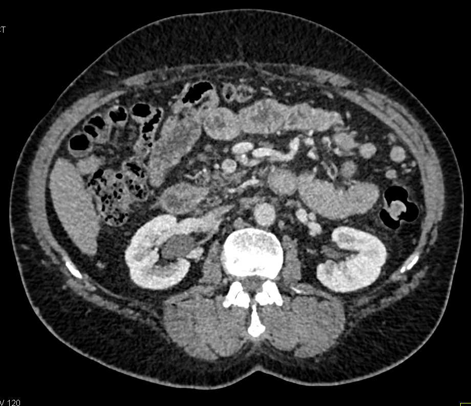 CCTA with Left Anterior Descending Coronary Artery (LAD) Plaque and Stenosis Under 50% - CTisus CT Scan