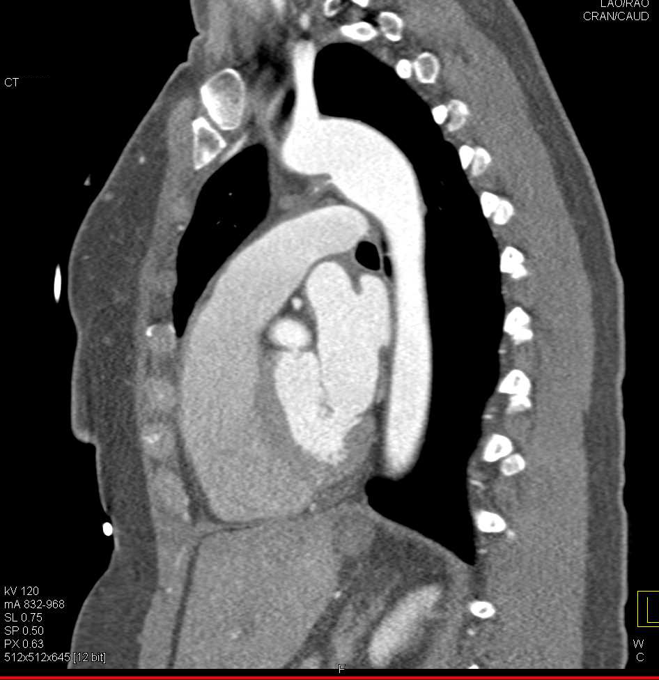 PDA or Patent Ductus Arteriosus - CTisus CT Scan