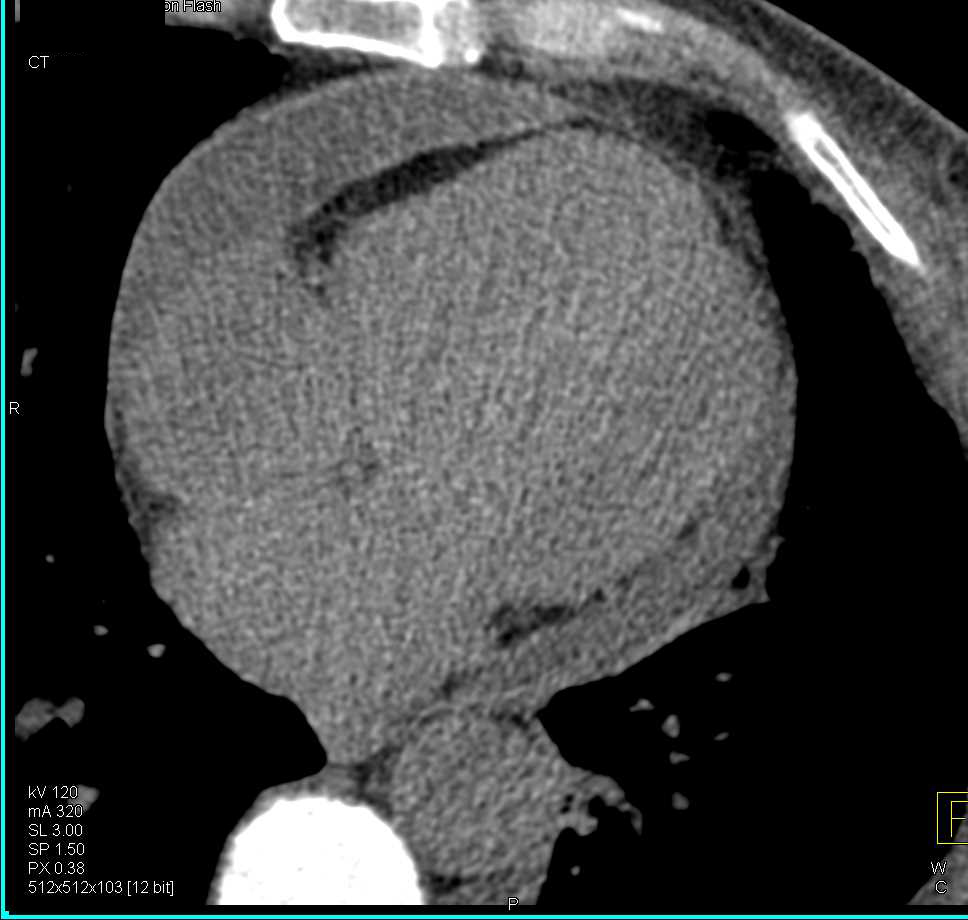 Pericardial Effusion - CTisus CT Scan