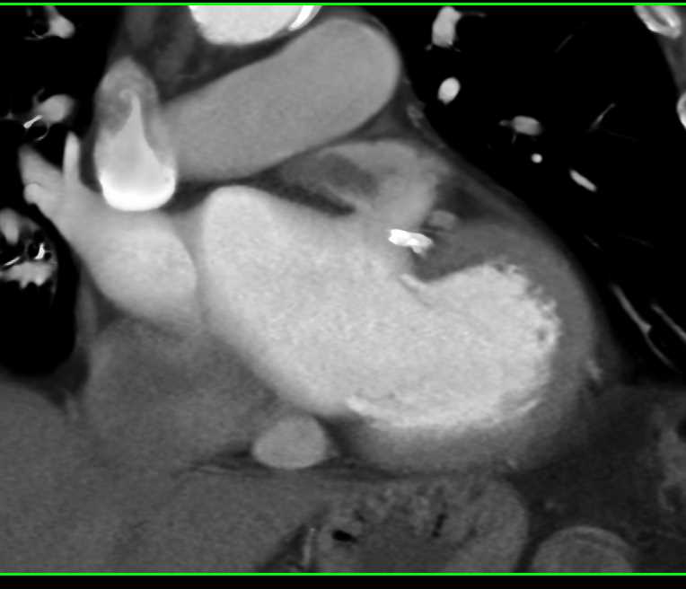 Thrombus in the Left Atrial Appendage - CTisus CT Scan