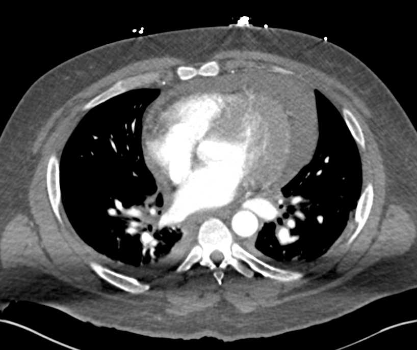 Hemopericardium - CTisus CT Scan