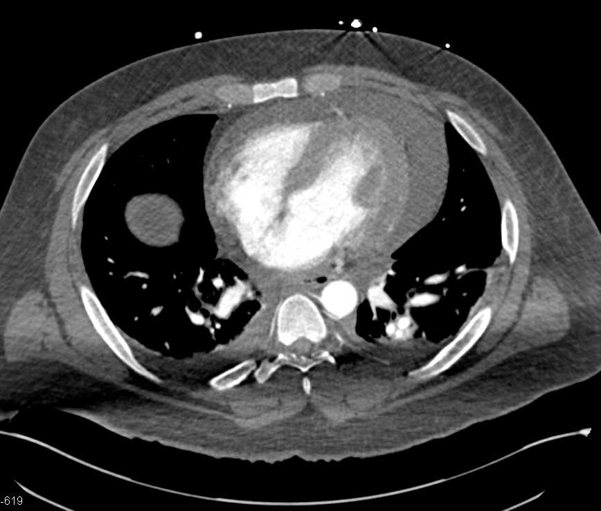 Hemopericardium in 3D - CTisus CT Scan
