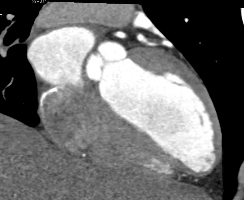 CCTA: High Grade Stenosis in the Left Anterior Descending Coronary Artery (LAD) - CTisus CT Scan