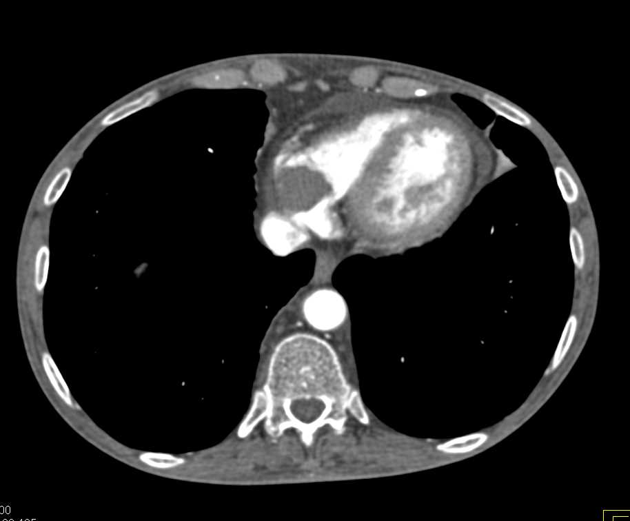 Clot in the Right Atrium - CTisus CT Scan