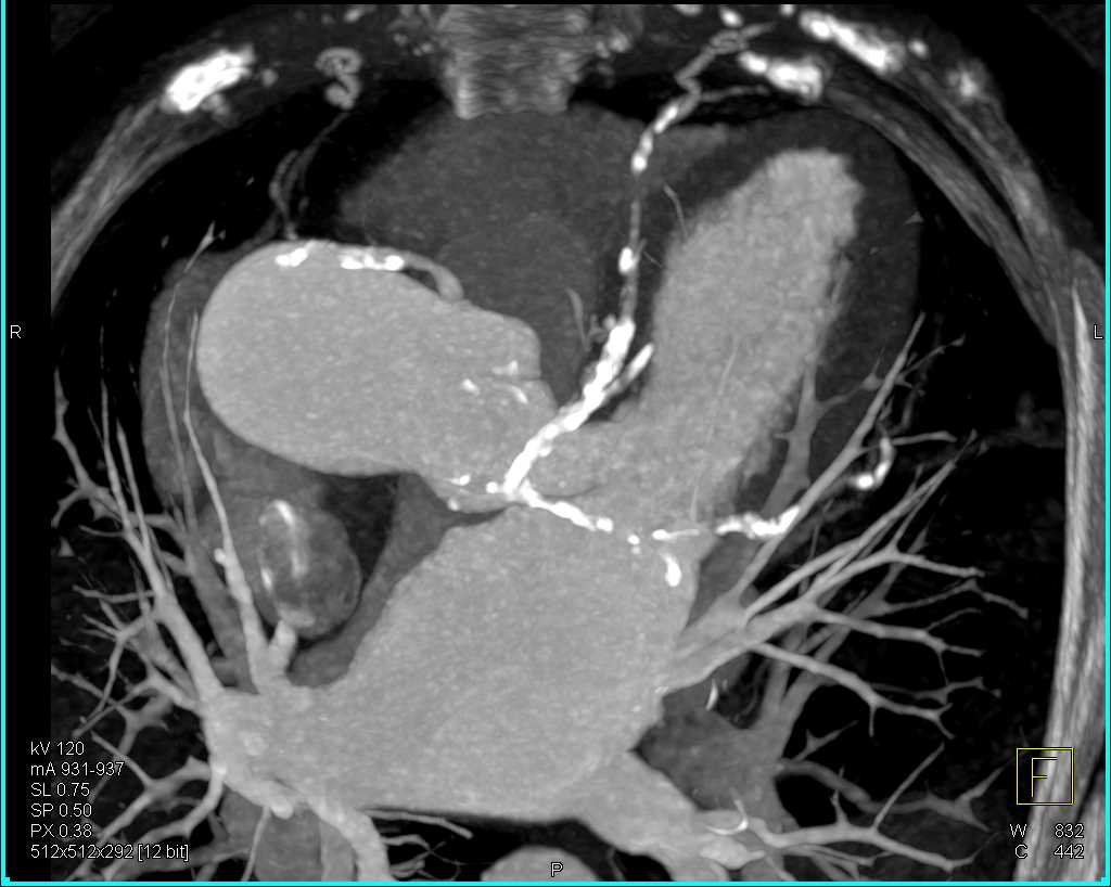 Extensive Coronary Artery Calcification - CTisus CT Scan