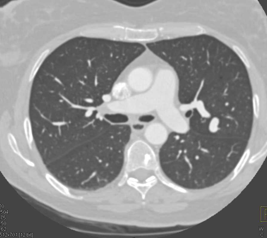 Pulmonary Arteriovenous Malformation (AVM) in 3D - CTisus CT Scan