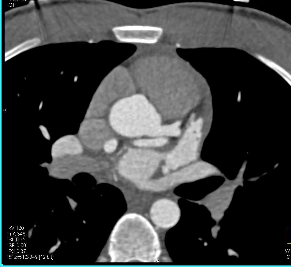 Coronary Artery Fistulae from Circumflex Coronary Artery to Right Atrium/Superior Vena Cava (SVC) Junction - CTisus CT Scan