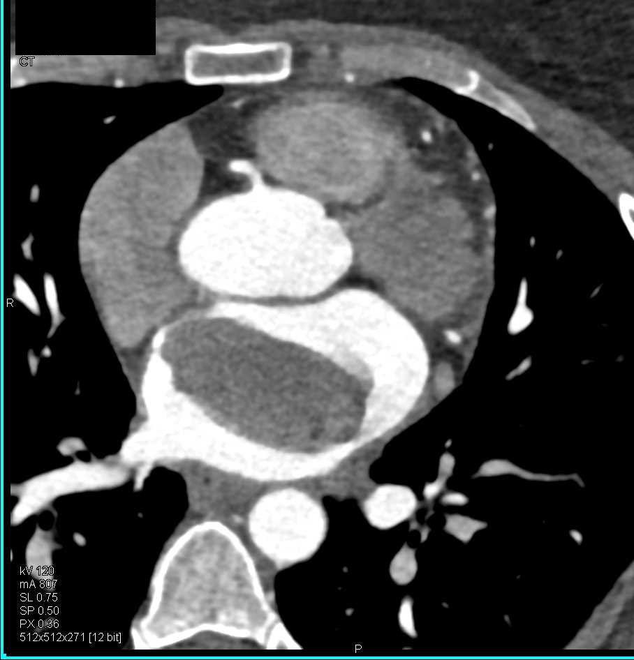 Left Atrial Myxoma Which Could be Clot - CTisus CT Scan