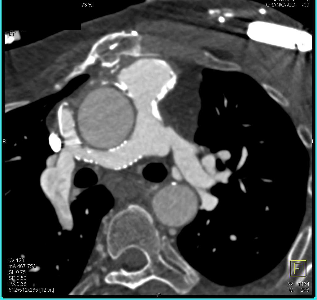 Patent Stent in the Right Pulmonary Artery - CTisus CT Scan