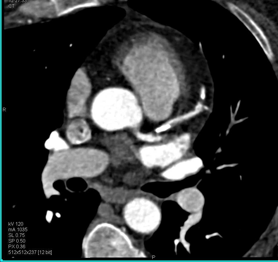 CCTA with Greater Than 50% Left Anterior Descending Coronary Artery (LAD) Stenosis - CTisus CT Scan