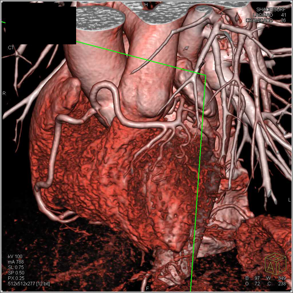 Left Coronary Artery Arises off the Right Cusp - CTisus CT Scan