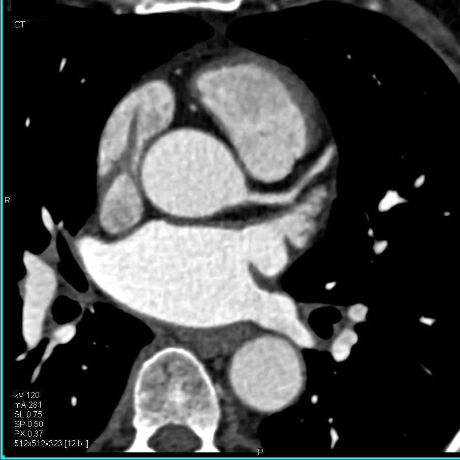 CCTA: Circumflex Coronary Artery Arises off the Right Cusp - CTisus CT Scan