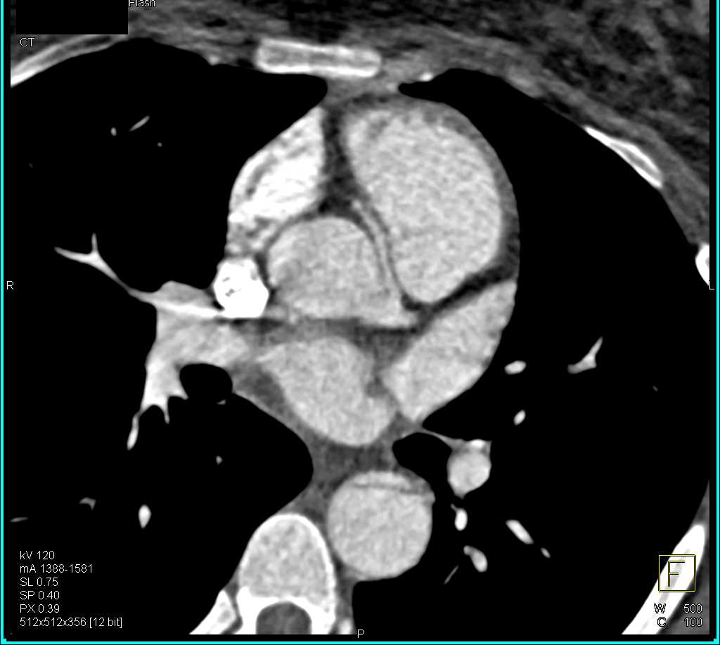 CCTA: Right Coronary Artery (RCA) arises off Left Cusp in a Malignant Configuration - CTisus CT Scan