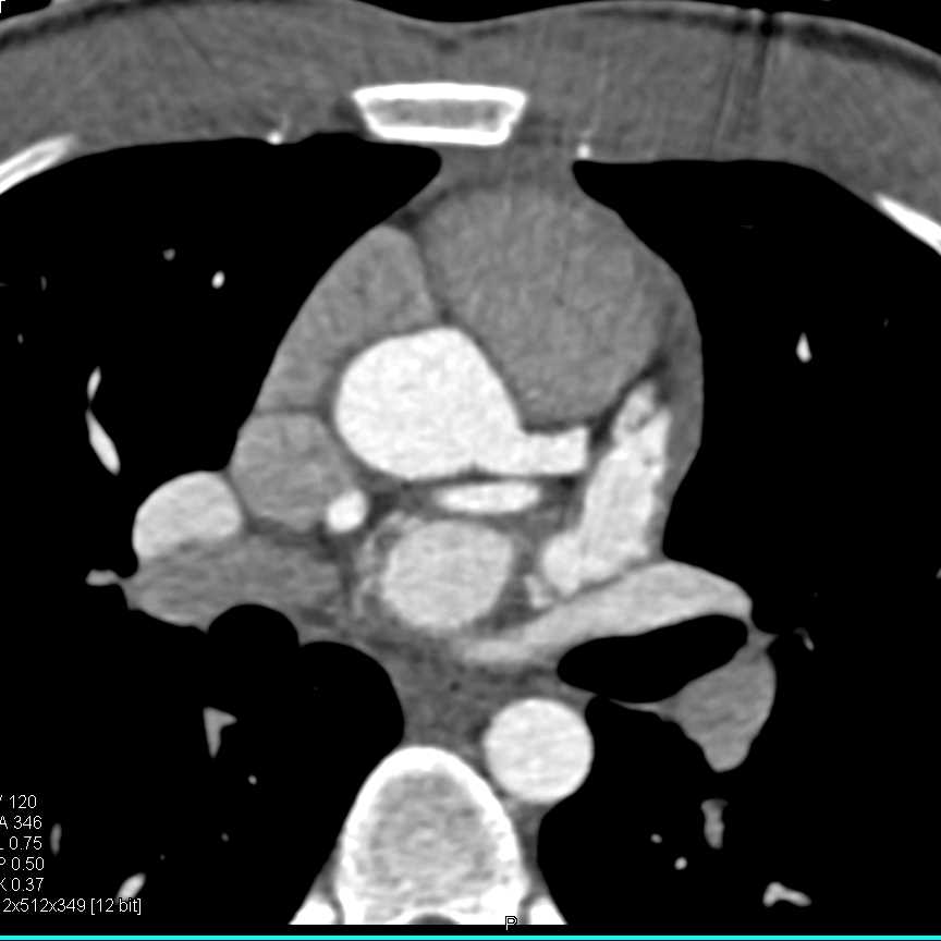 CCTA: Left Coronary Artery Aneurysm - CTisus CT Scan