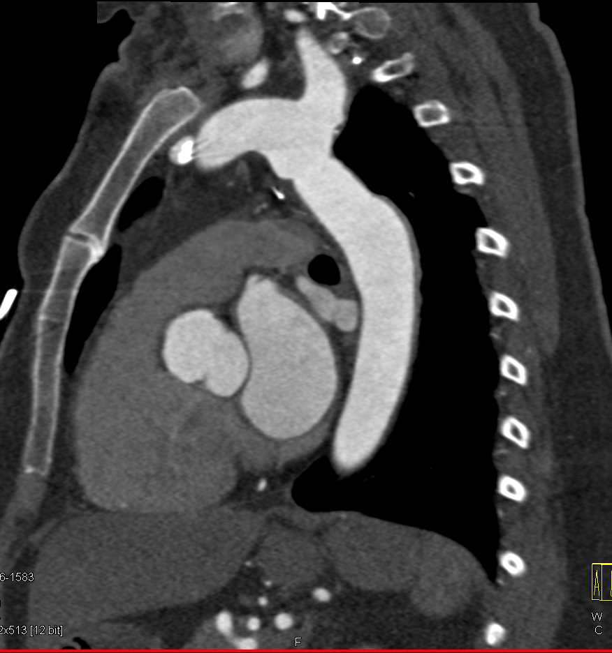 Changes Post Coarctation of the Aorta Repair - CTisus CT Scan