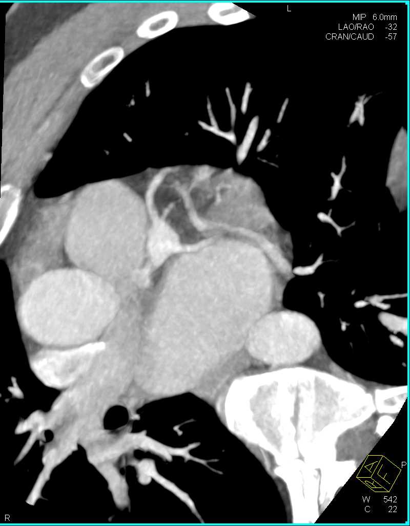 Coronary Artery Aneurysm of the Left Anterior Descending Coronary Artery (LAD) - CTisus CT Scan