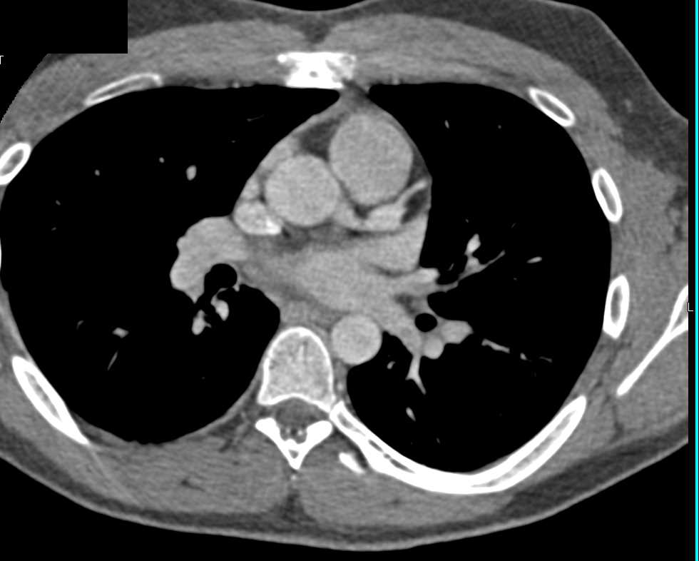 Coronary Artery Aneurysm of the Left Anterior Descending Coronary Artery (LAD) - CTisus CT Scan