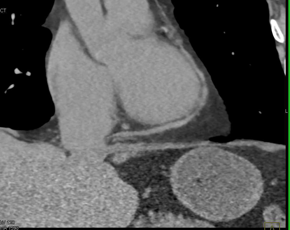 Pericarditis with Thickened Pericardium - CTisus CT Scan