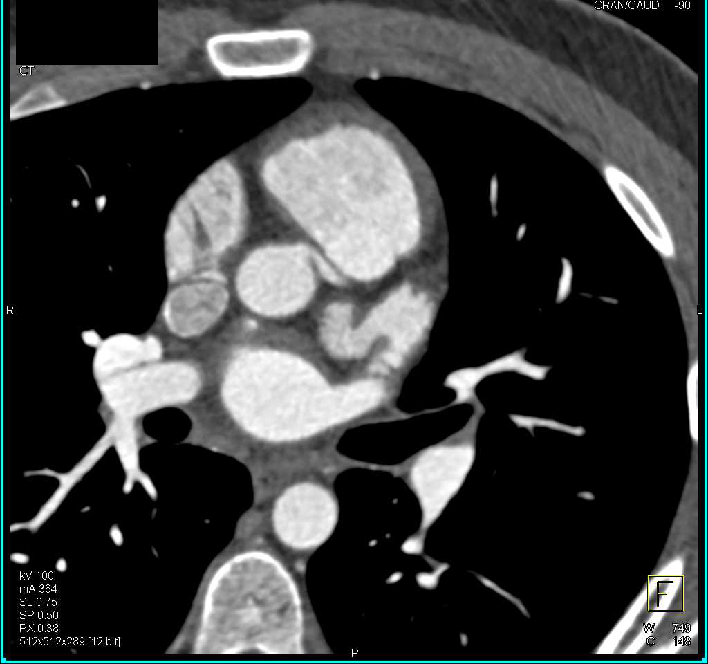 Coronary CTA with No Evidence of Stenosis - CTisus CT Scan
