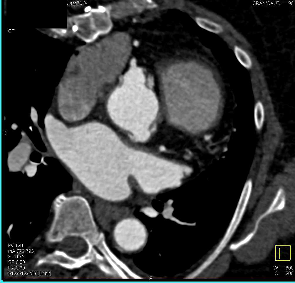 Post Aortic Valve Replacement (AVR) with Dilated Coronary Arteries at Reimplantation Sites - CTisus CT Scan