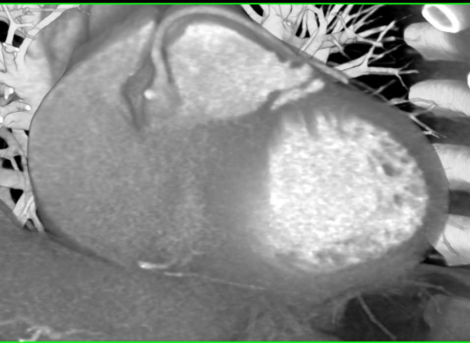 CCTA: Let Coronary Artery Arises off the Right Cusp - CTisus CT Scan