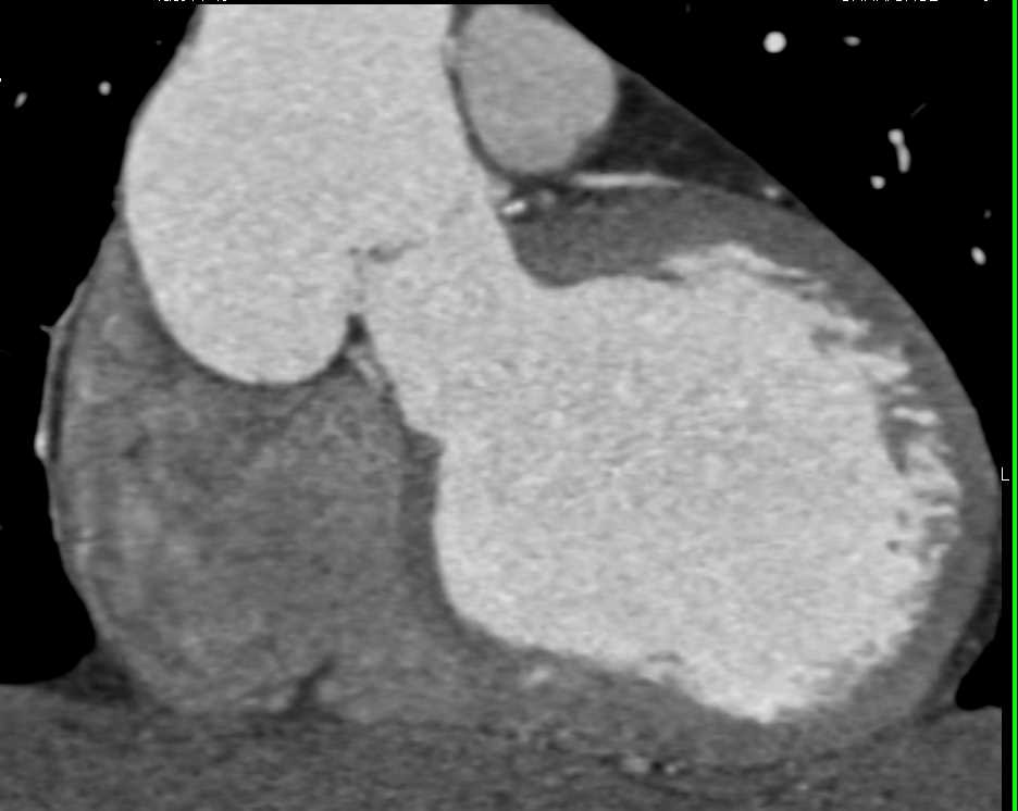 Pseudoaneurysm off Sinus of Valsalva - CTisus CT Scan