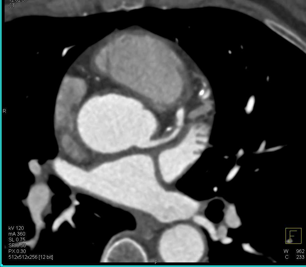 CCTA with 70% Left Anterior Descending Coronary Artery (LAD) Stenosis - CTisus CT Scan
