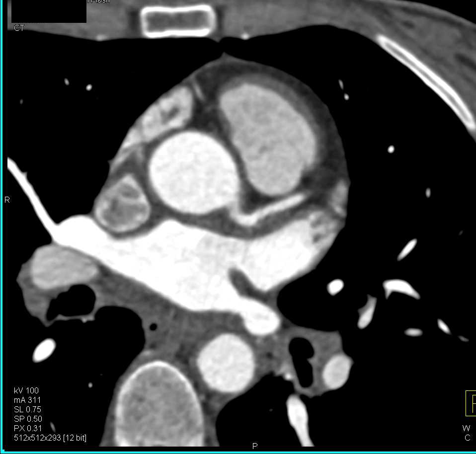 CCTA with Calcified Plaque in Left Anterior Descending Coronary Artery (LAD) - CTisus CT Scan