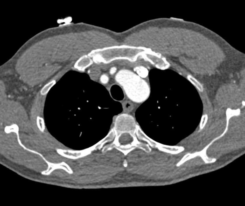 Prior Repair of Coarctation of the Aorta - CTisus CT Scan
