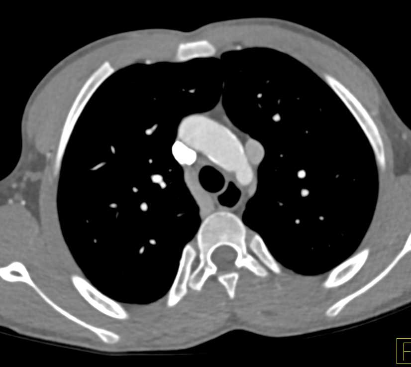 Persistent Left superior vena cava (SVC) - CTisus CT Scan