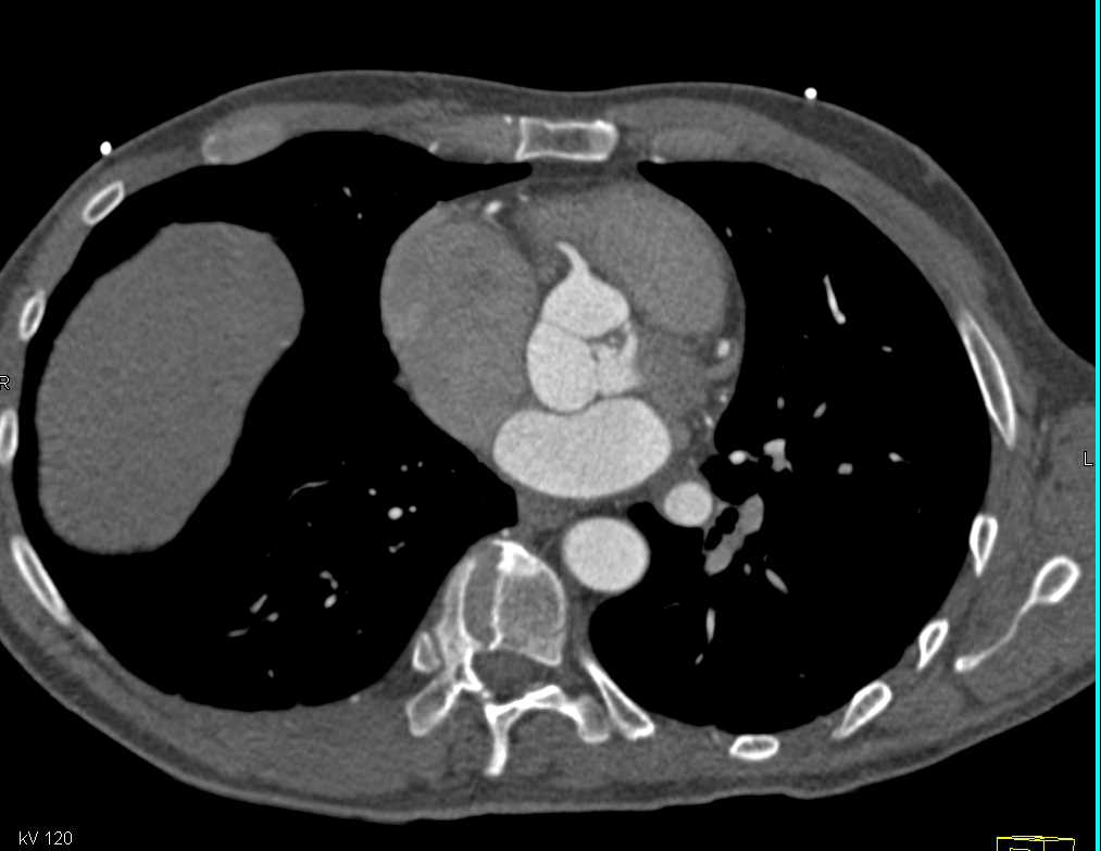 Thrombus on the Aortic Valve - CTisus CT Scan