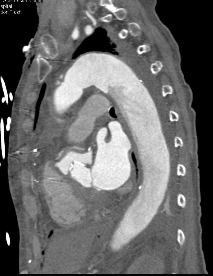 Type A Dissection with Repair - CTisus CT Scan
