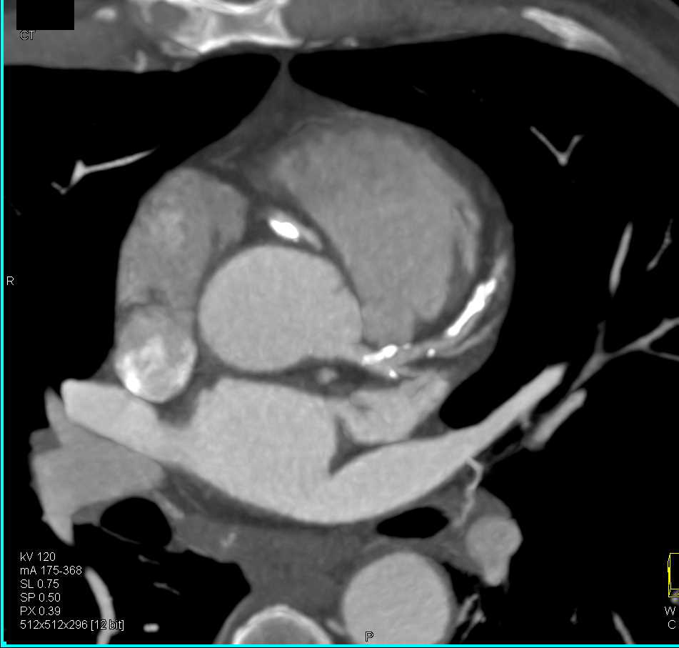 CCTA: High Grade Left Anterior Descending Coronary Artery (LAD) Stenosis - CTisus CT Scan