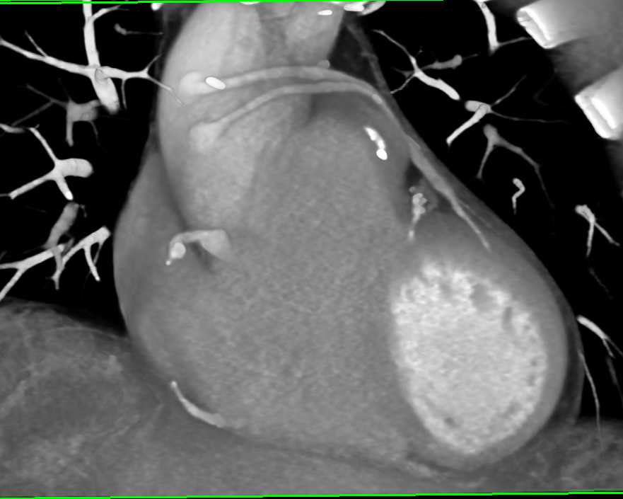 Two Left Venous Coronary Artery Bypass Grafts - CTisus CT Scan
