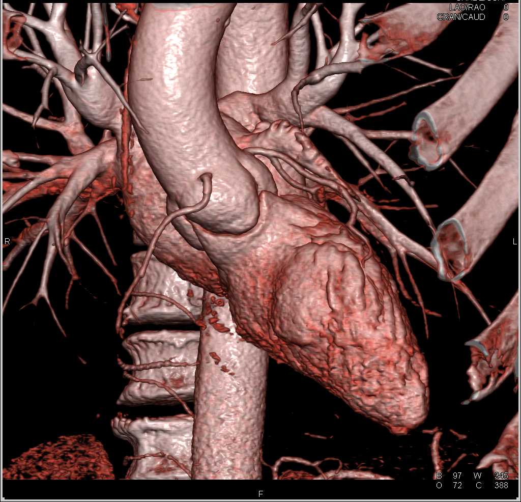 CCTA-Normal Coronary Arteries - CTisus CT Scan