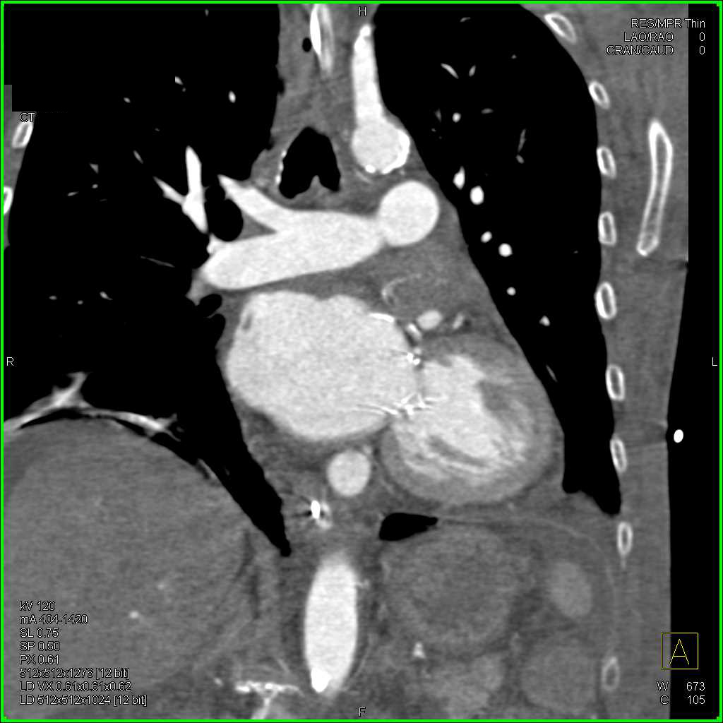 Aortic Valve repair - CTisus CT Scan