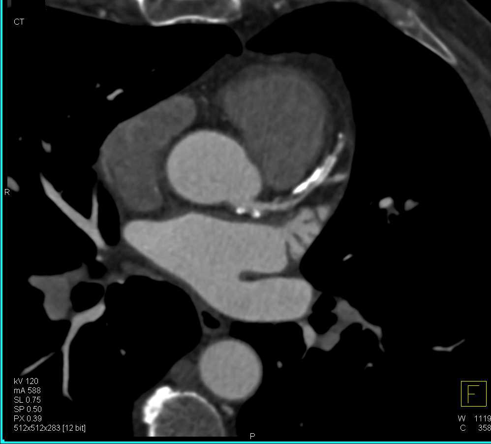 CCTA: High Grade Stenosis Left Anterior Descending Coronary Artery (LAD) - CTisus CT Scan