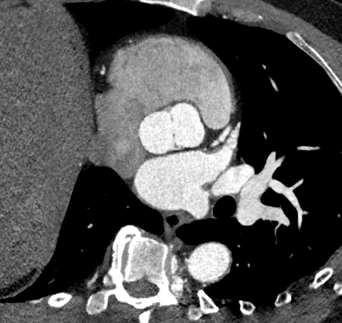 Bicuspid Aortic Valve - CTisus CT Scan